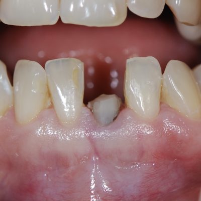 Caso 1: Antes (Fractura vertical de diente 3.1)