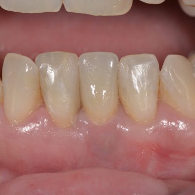 Caso 1: Después (Instalación corona definitiva)