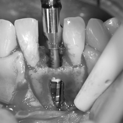 Fresado para implante de titanio