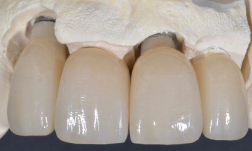 Creación de coronas de porcelana definitivas