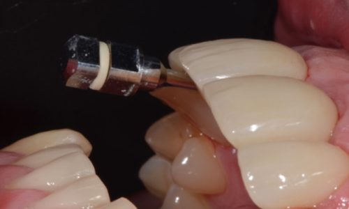 Instalación de coronas definitivas